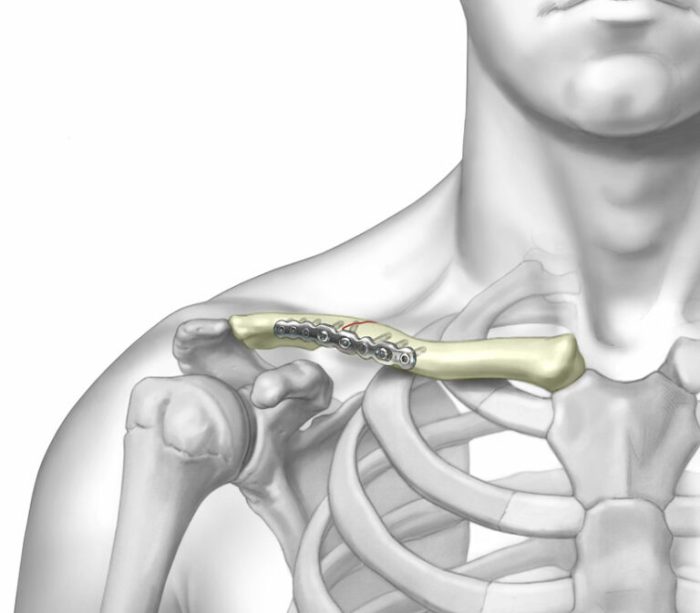 Clavicle midshaft fracture plating